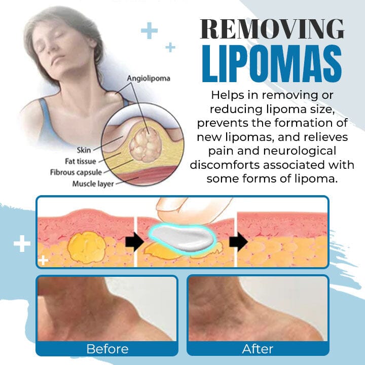 South Moon™ Lipoma Removal Ointment